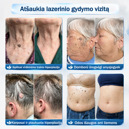 👨‍🔬🧊 Oficiali parduotuvė | ✅ Rolimey® 7 dienų roll-on priemonė odos ataugėlėms, karpoms ir pigmentinėms dėmėms-7141