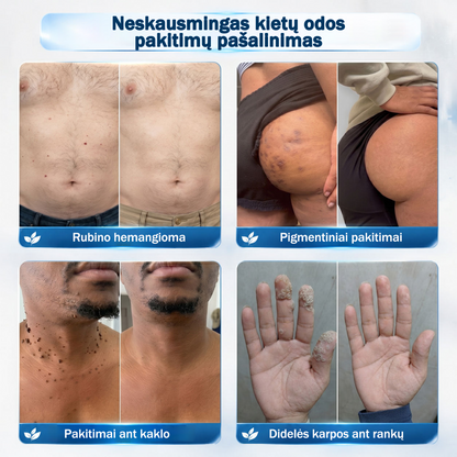 👨‍🔬🧊 Oficiali parduotuvė | ✅ Rolimey® 7 dienų roll-on priemonė odos ataugėlėms, karpoms ir pigmentinėms dėmėms-7141