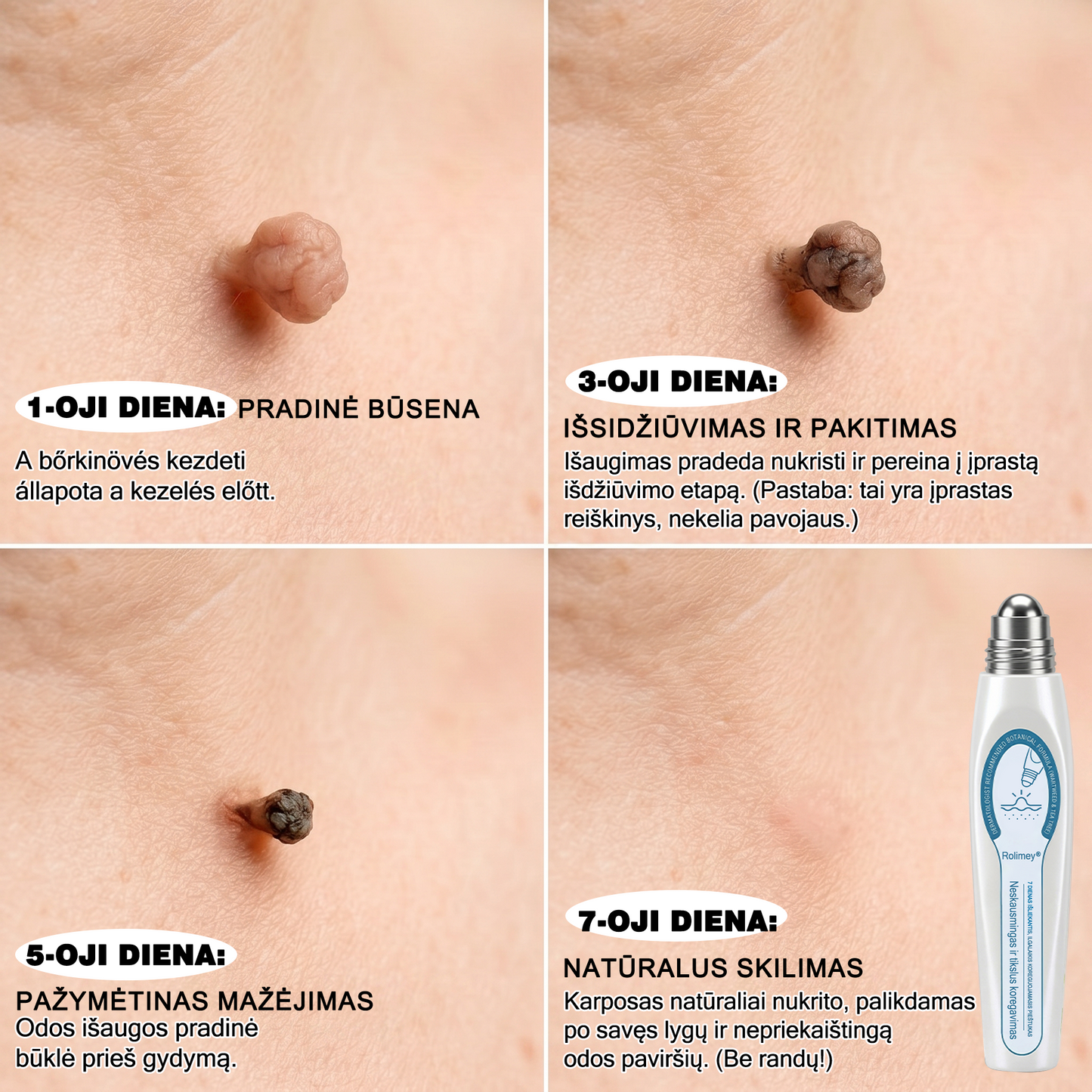 👨‍🔬🧊 Oficiali parduotuvė | ✅ Rolimey® 7 dienų roll-on priemonė odos ataugėlėms, karpoms ir pigmentinėms dėmėms-7141